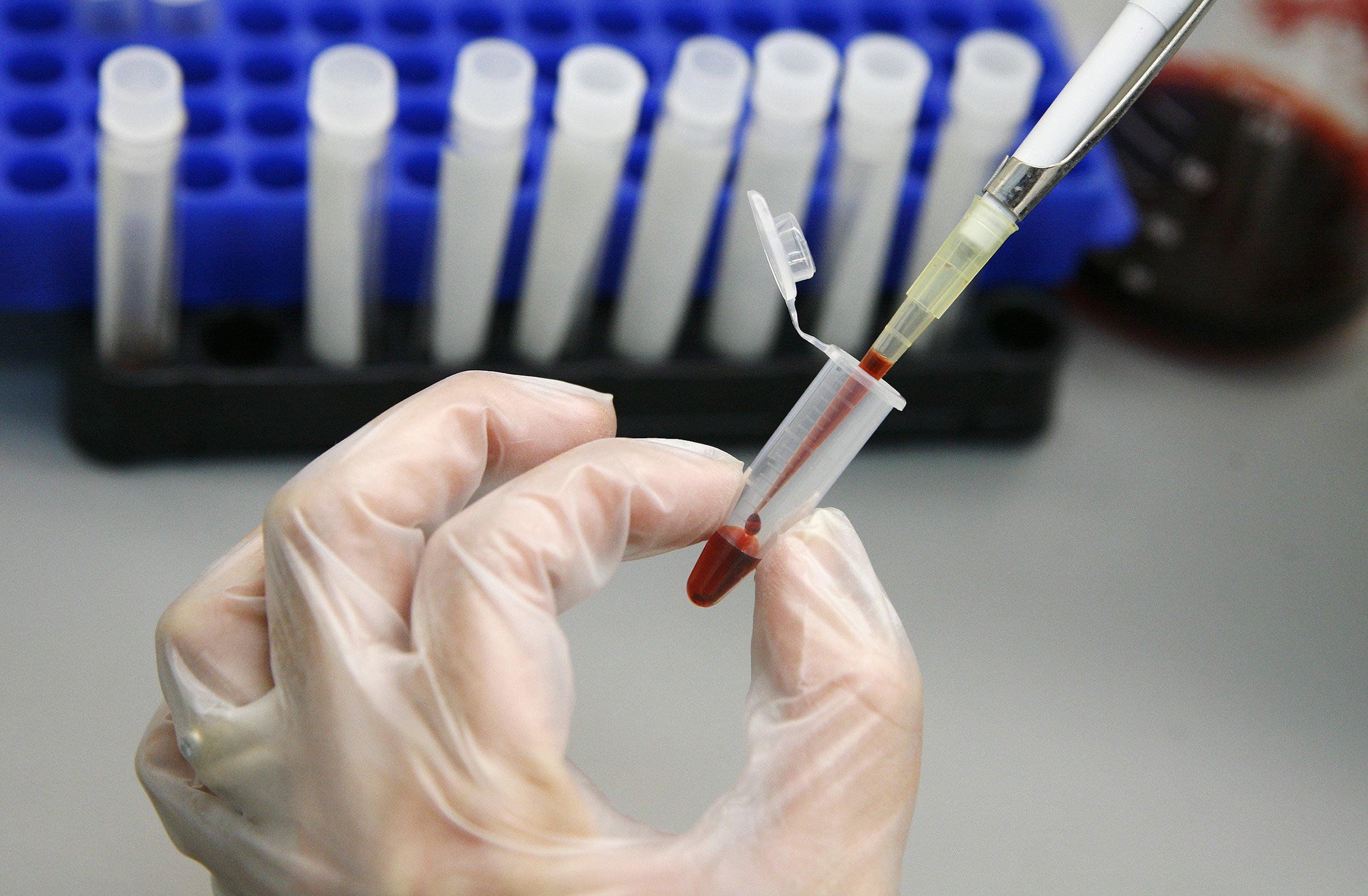 Кровь больного вич. Исследование на ВИЧ. Тест на ВИЧ. Обследование на гепатит с.